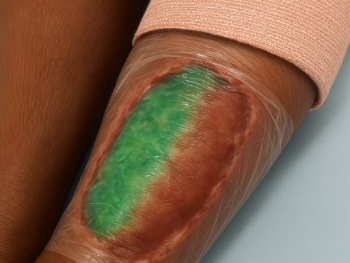 Rijetka bakterija "jedačica mesa" odnijela osam života na jugu SAD-a